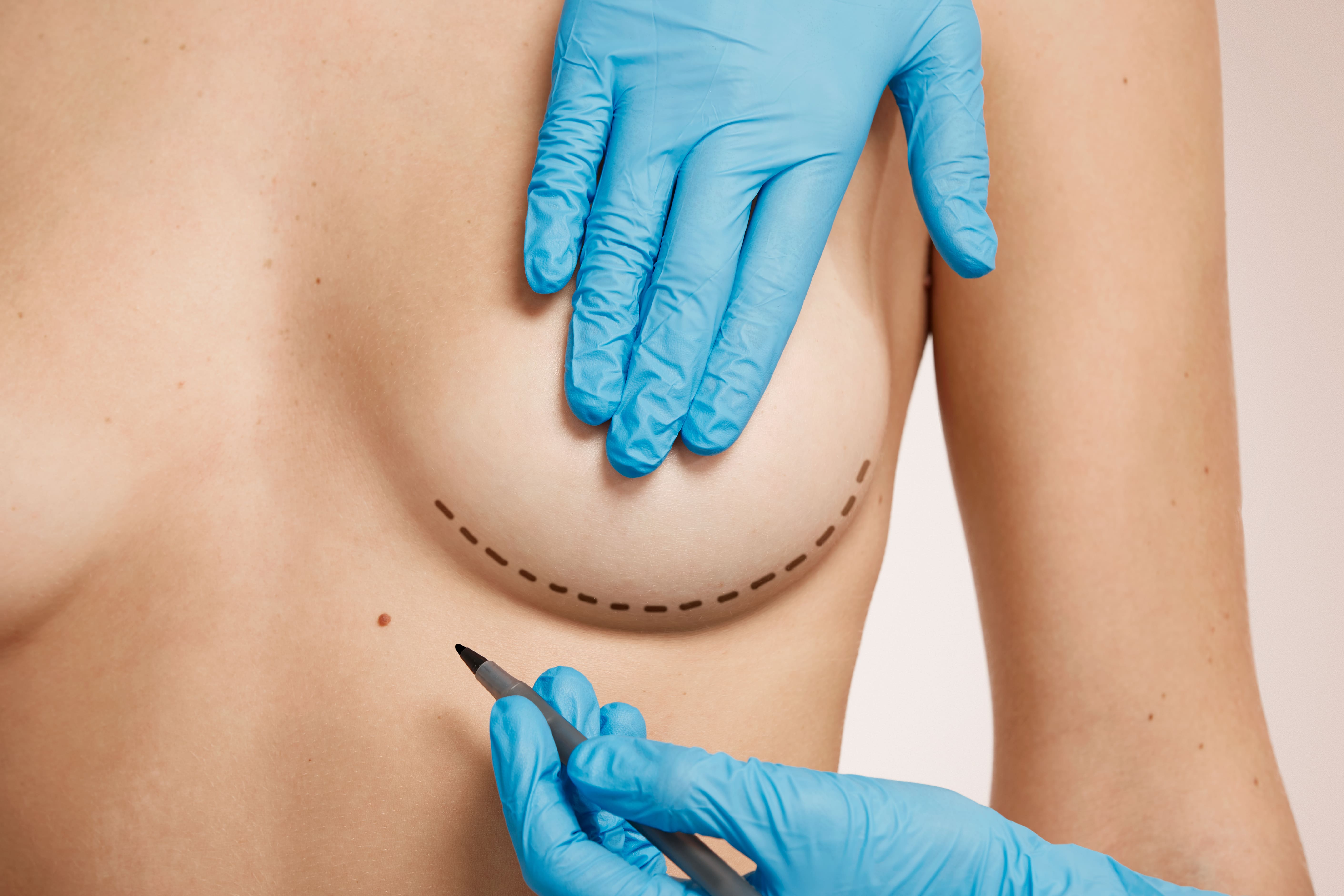¿Cómo elegir el tamaño de implante mamario ideal para tu cuerpo?